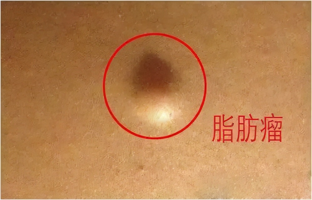 龚俊|医生眼里善良的6种“瘤”,查出来别怕,恶化的几率微乎其微