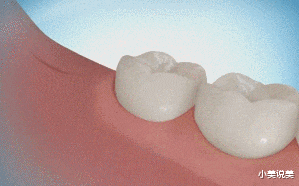 小美说美 智齿不痛的话可以不拔吗