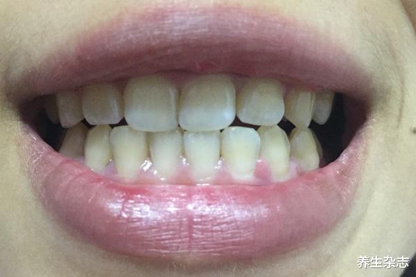 养生杂志|过了40岁,若牙齿还能保持这3个状态,说明你的牙保养的不错,若缺少一个,需引起重视了!