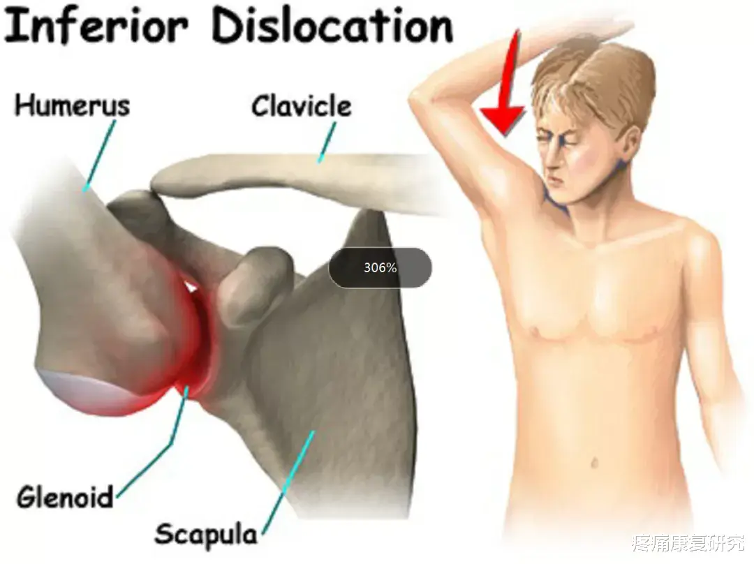 熬夜|三种常见的肩关节脱位及治疗