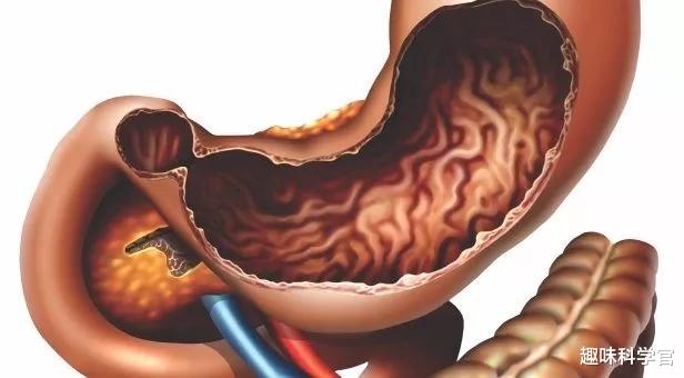 博蒙特 成就全人类的圣马丁：胃部骇人大洞，8年238次人体实验