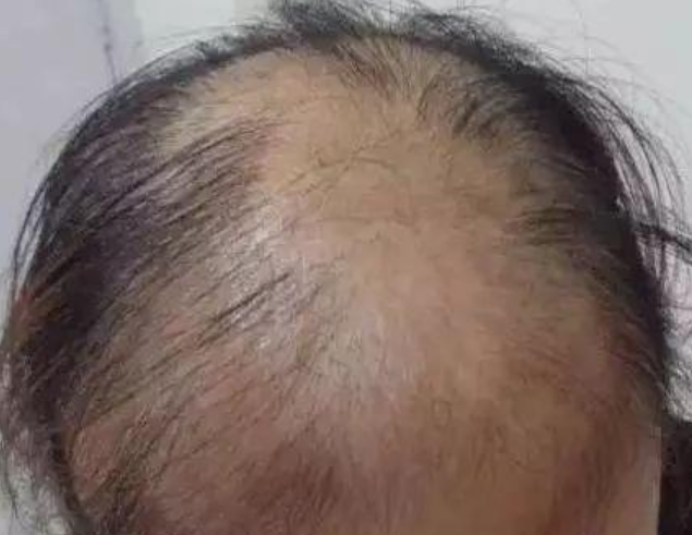 社会侦探员 韩媒称中国人脱发面积约等于10个首尔，建议韩企进军脱发行业