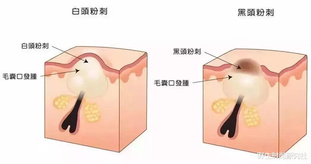 黑头 洗完脸别着急擦水乳，难怪黑头粉刺去不掉，皮肤比别人差
