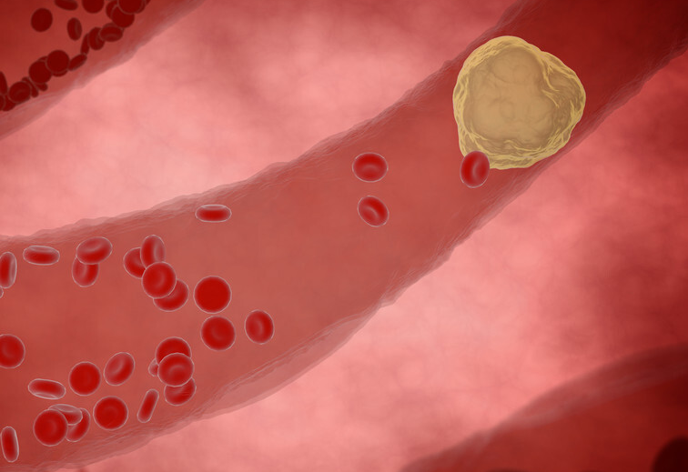 洋葱|58岁男子饭后突然晕倒，医生：1物比猪油还升血脂，建议撤下饭桌