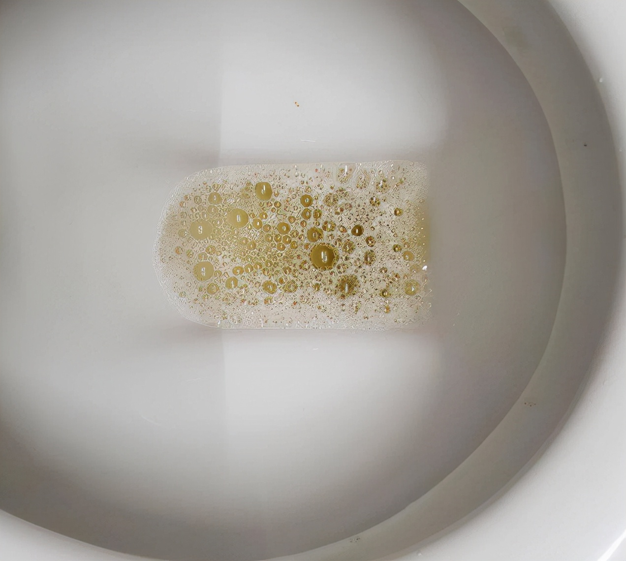 尿酸|男生“尿尿”出现3种迹象，尿酸或已“悄然升高”，占其一，早做检查