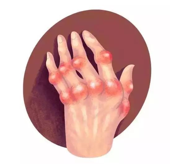 克罗恩病 中科西部干细胞研究院：干细胞治疗治疗炎症性疾病效果可喜 !