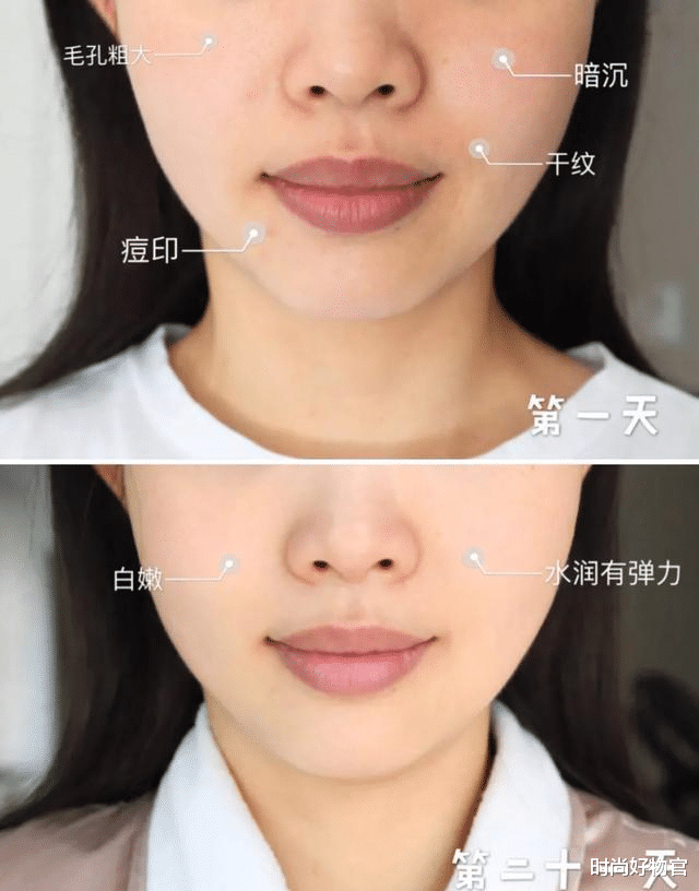 时尚好物官|女子为去皱纹连扎20多针除皱针，竟变成这模样？网友：幸好没跟风