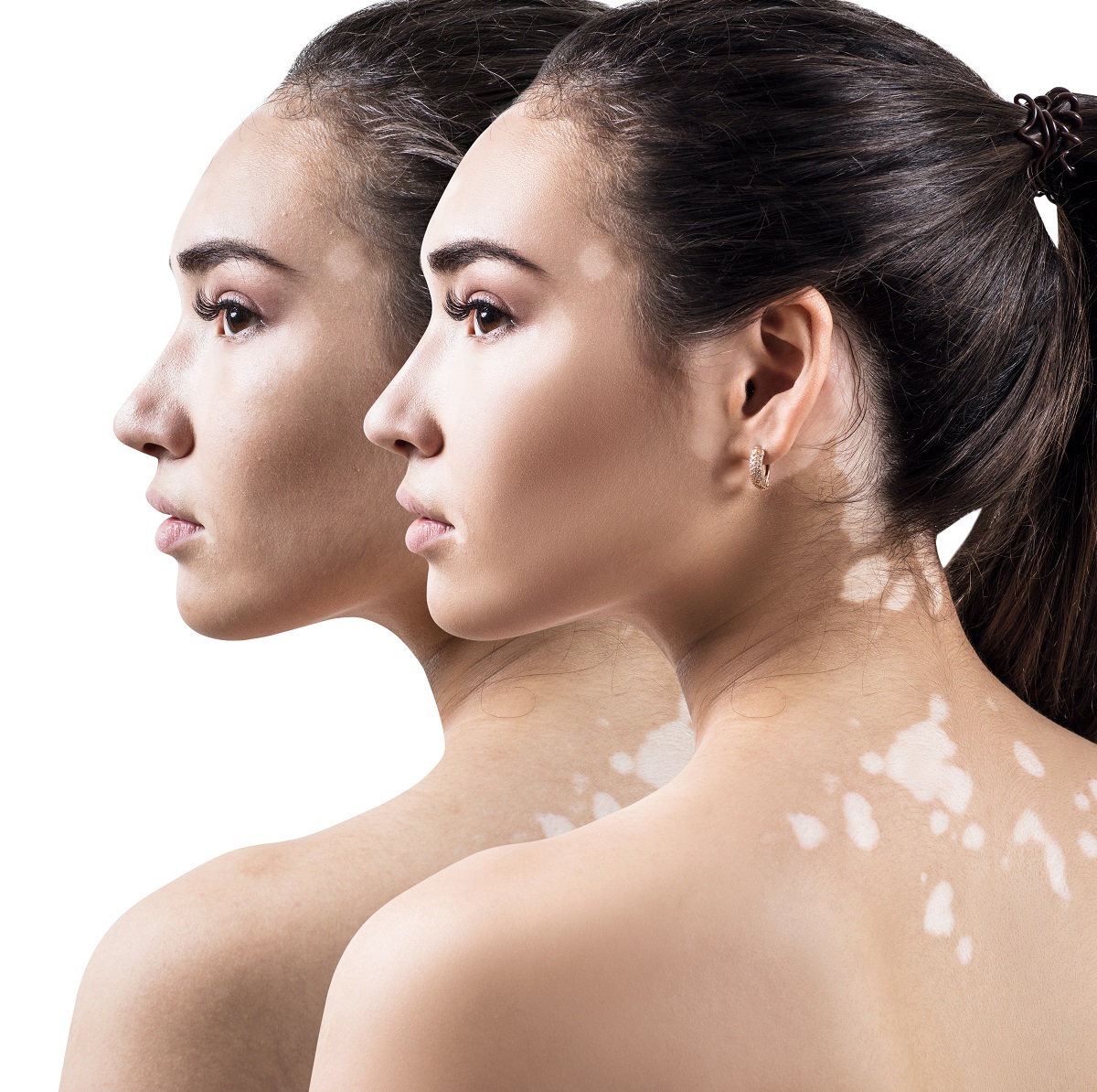 益药健康|夏季白癜风的高发季,这几个方面一定要注意!