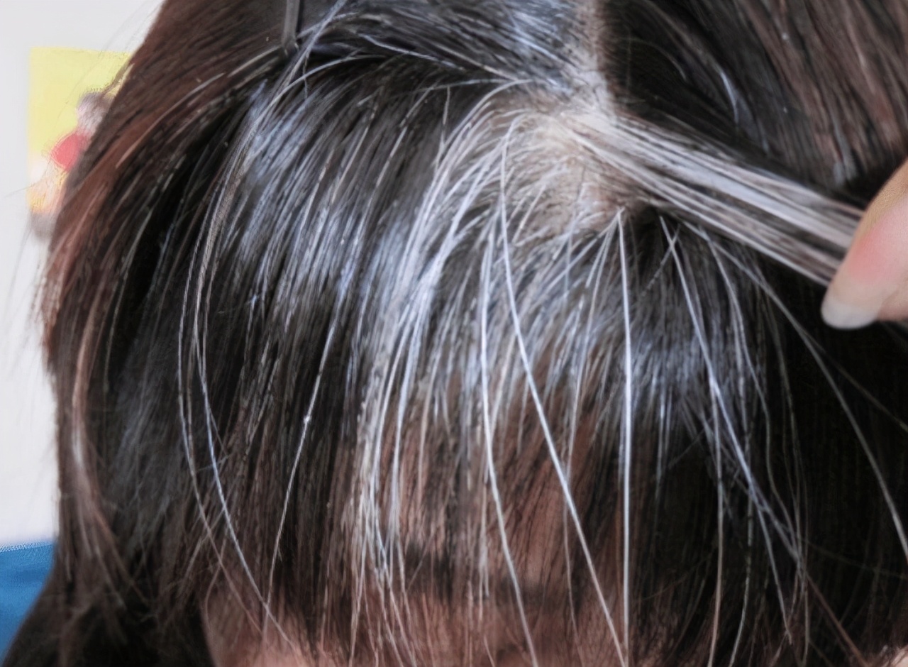 衰老|不到40就开始白头发,是身体在衰老吗?医生:多半是这3个原因造成的