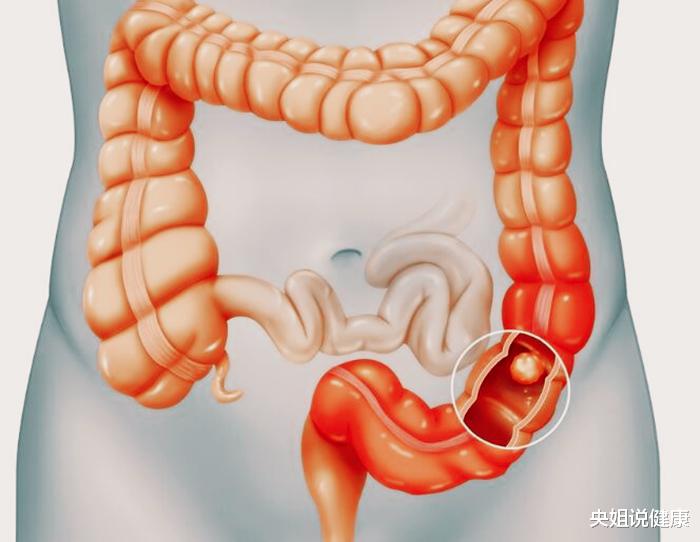 肠癌|不声不响，肠癌一查就是晚期？上厕所出现四个异常，劝你早查肠镜