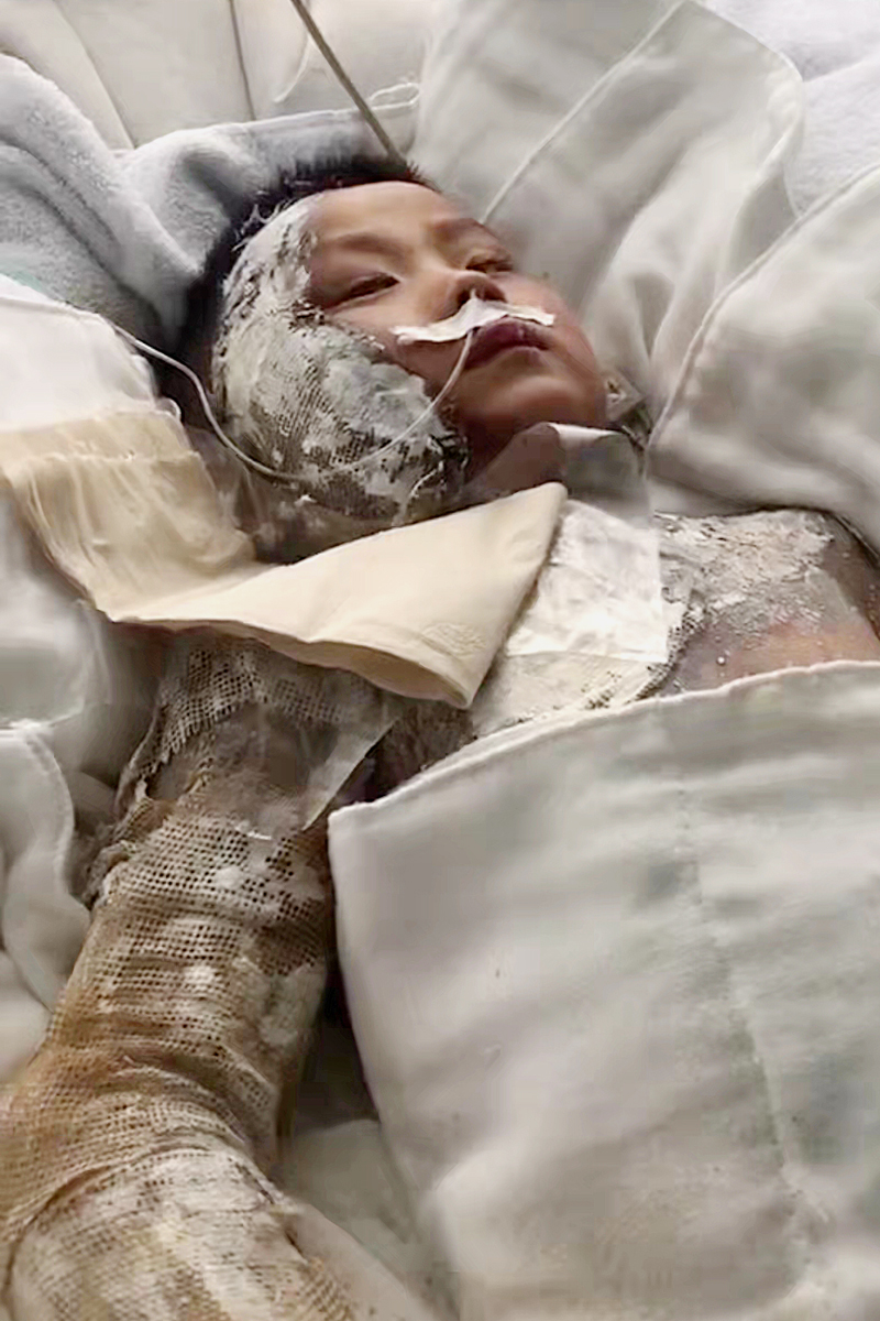 用了11年的太阳能热水器突然爆裂,6岁男孩被严重烫伤,妈妈崩溃