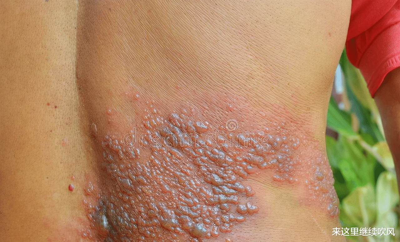 带状疱疹|有没有治疗带状疱疹的中药方子？听听中药师怎么说