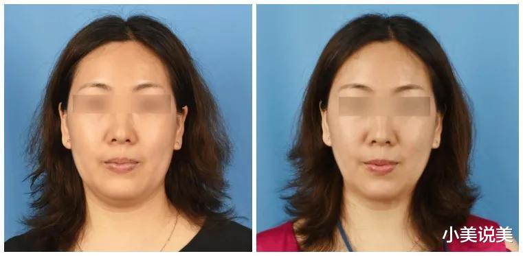 小美说美 超声炮能解决哪些问题？超声炮效果怎么样？