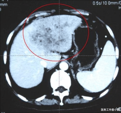胃癌|26岁女白领查出肝癌，2月后离世，医生：腹部早有提醒，她没在意