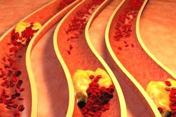 熊猫医学社|吃一次相当于10斤山楂，心血管医生：常吃或可降血脂，血栓脑梗不叨扰