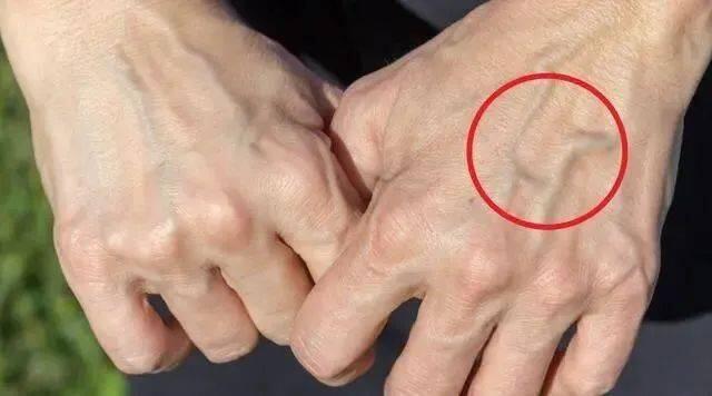 骨密度|青筋越多说明越淤堵