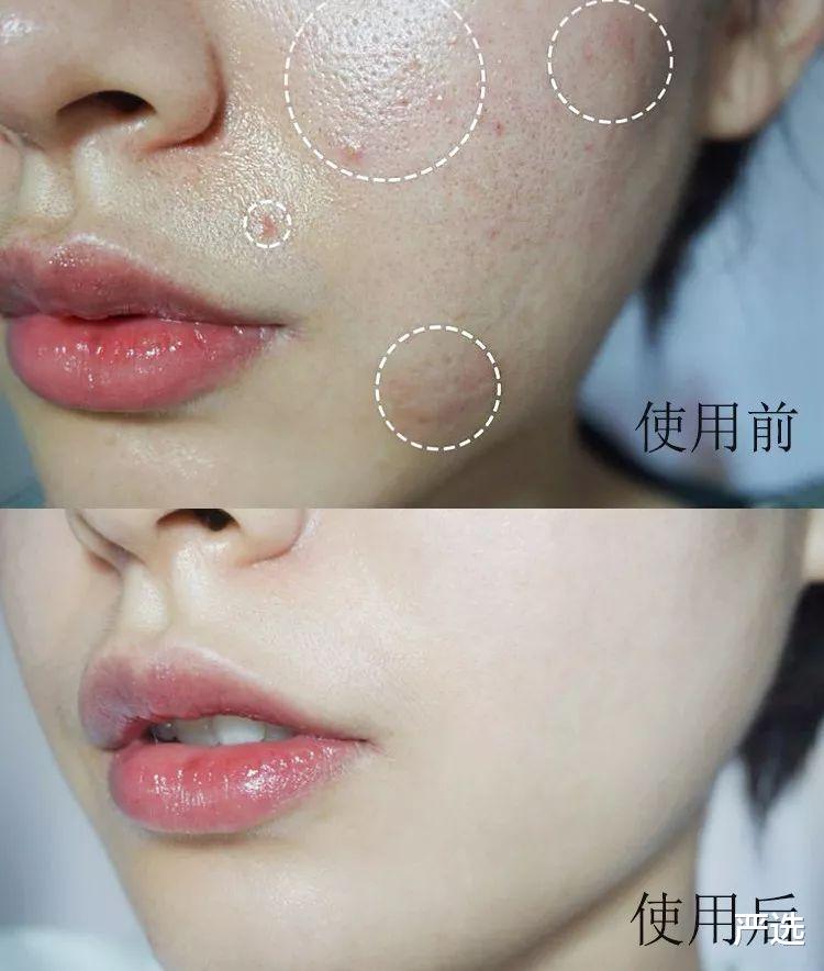 严选|我真没做医美！坚持每晚使用美容仪，半年不到却被说像换了皮