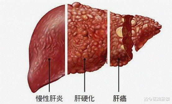 古今医案研读 肝癌的“源头”被揪出，不是烟酒，远离这2物，肝脏会感激你