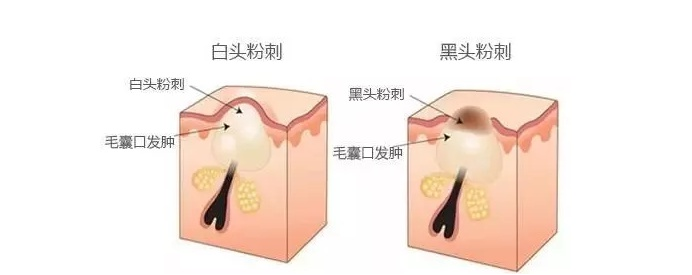 黑头|黑头粉刺不断惹人烦，去除它们要用对方法！