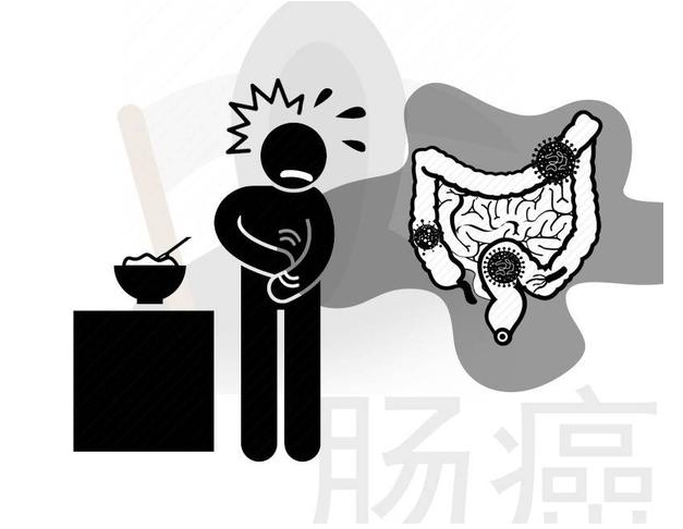 肠癌|排大便时，总是前端硬后面软，是肠癌吗？医生为你解惑，不妨看看