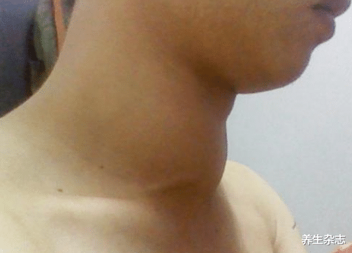 甲状腺疾病|甲状腺病源头已公布，“3素食”害人不浅，提醒家人要远离