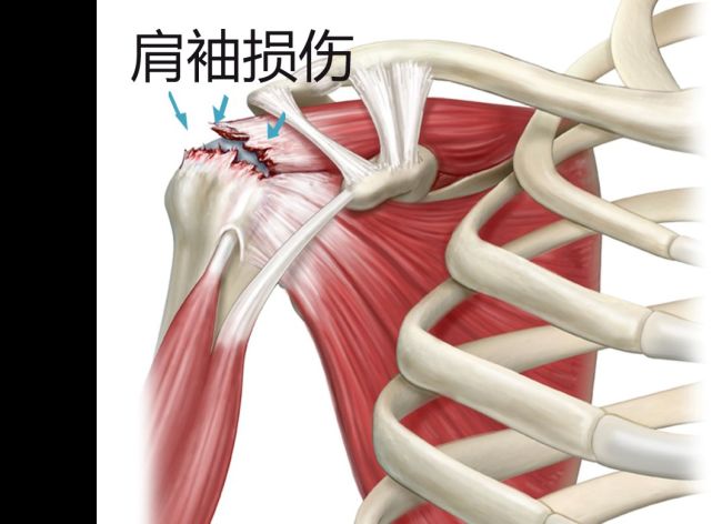 鸡胸肉|肩袖损伤是怎么回事?