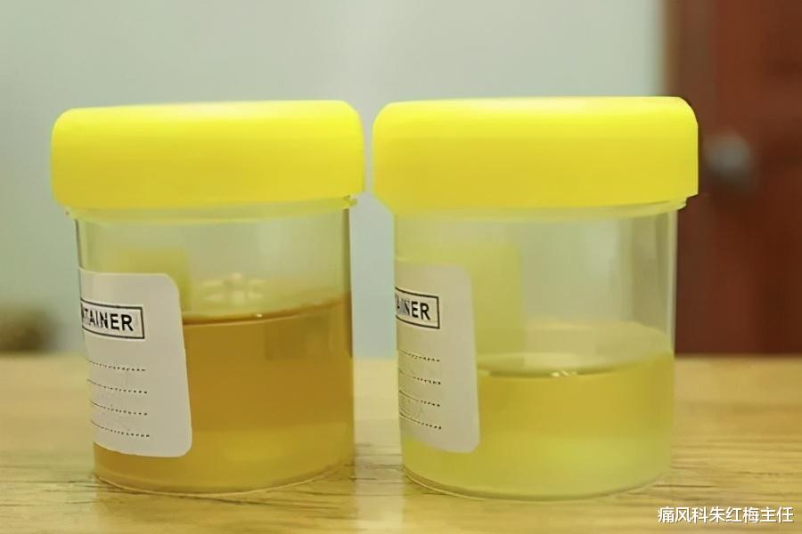 痛风科朱红梅主任|一直在治疗、痛风却没有得到有效治疗！