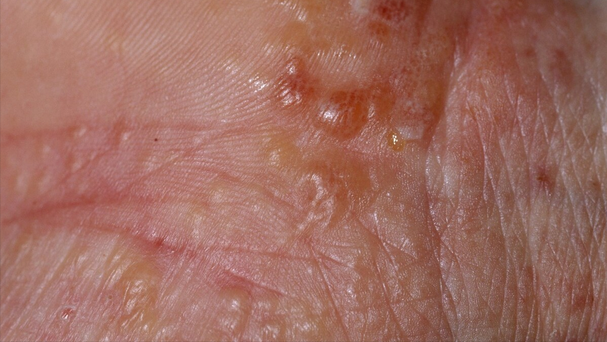 祥光堂 血糖升高皮肤瞒不住？医生提醒：皮肤若有3种表现你该控糖了