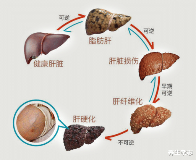 养生杂志|30岁男子,1个月转氨酶由184降到30,肝胆医生颔首:吃它没有错!