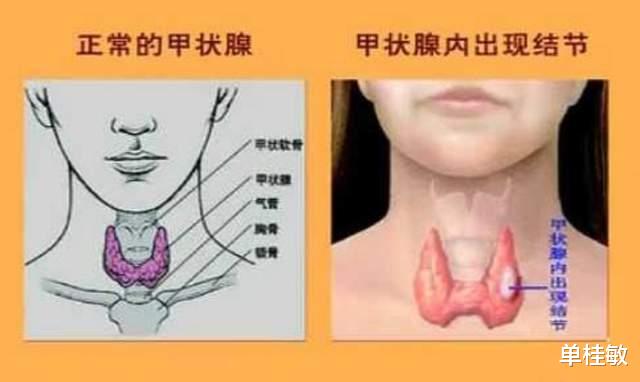 长寿|甲状腺结节4a级艾灸缩小又肿大正常吗？