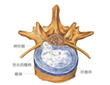 邱氏悬壶|腰椎间盘突出腿疼该怎么办?锻炼方法有哪些?邱氏悬壶