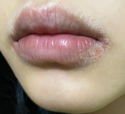 润唇膏 千万不要乱用孕妇润唇膏，曼秀雷敦诱发唇炎，凡士林猪油嘴