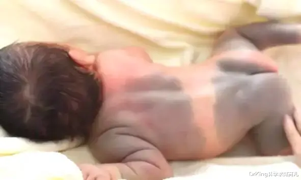 DrKing科学家庭育儿|听过100种胎记的传说,有人告诉你这几种胎记可致命吗?