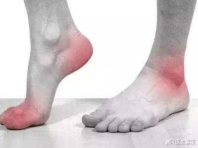 痛风医生崔丽|当痛风遇上脂肪肝,教你几招护肝小秘诀!