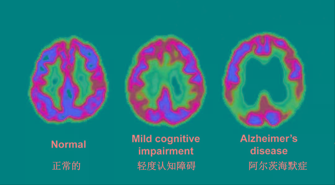 阿尔茨海默病|12种方法帮你预防和改善阿尔茨海默病
