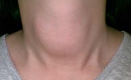 运动|44岁男子喝酒10年,甲状腺依然健康,医生直言:这2件事值得借鉴