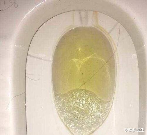 李锦秋医生 想知道肝好不好？又快又准的办法：用晨尿照照自己