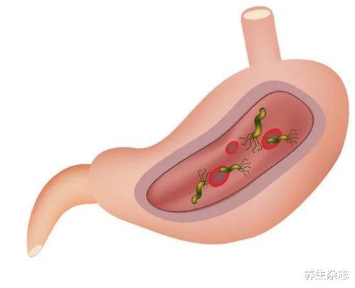 口臭|身体若出现3个异常，或是在提醒你：被幽门螺旋杆菌缠上了，医生：4个习惯重要