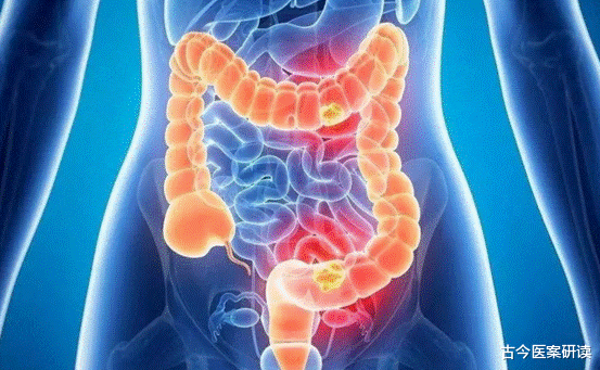 肠胃|母子2人相继确诊“肠癌”，医生咆哮：常吃3物，肠胃怎能受得了