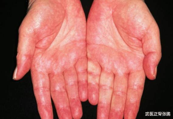 皮肤瘙痒|42岁大姐坚持“养肝”1年，肝功逐渐恢复，医生：2个习惯值得学习