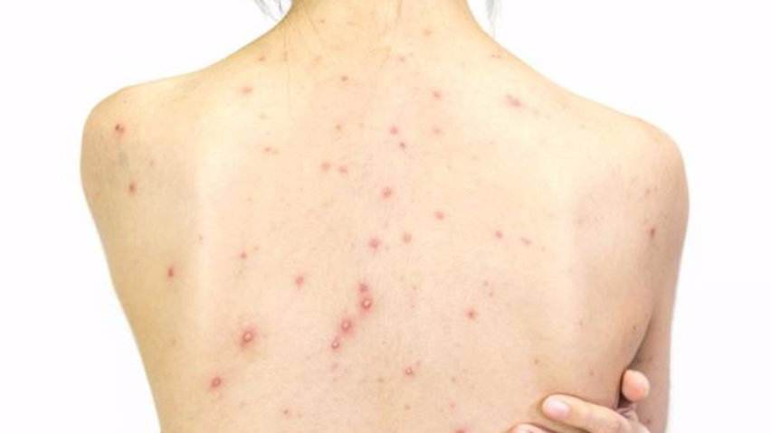 医生|20岁少女染HPV，疣体长满全身，竟是这件事造成的，医生：太不重视身体