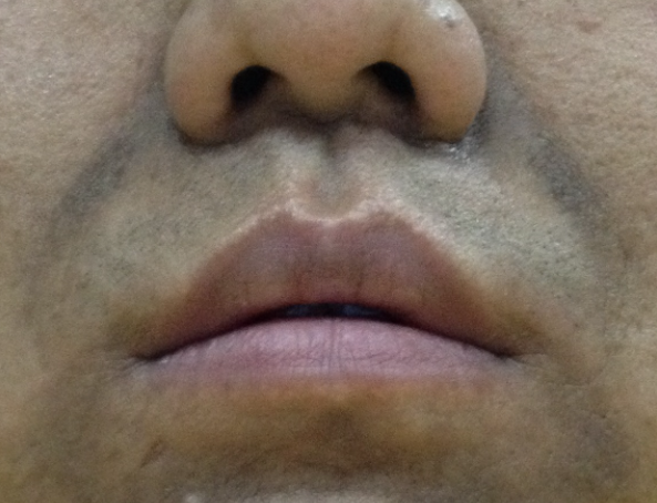 肺癌|56岁男子查出肺癌，后悔不已，医生：其实指头上早有“提醒”，很少人留意