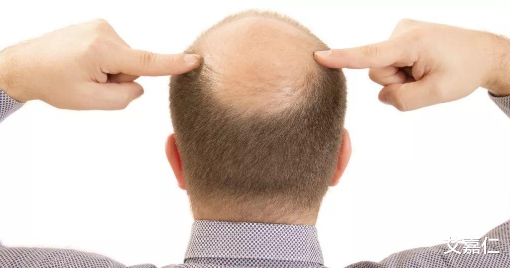 尿酸|艾嘉仁|脱发可能是湿气过重