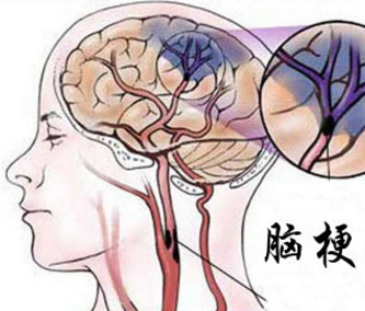 小米粥|神经内科专家：脑梗来临，身体2个月前会有“暗示”吗？了解一下