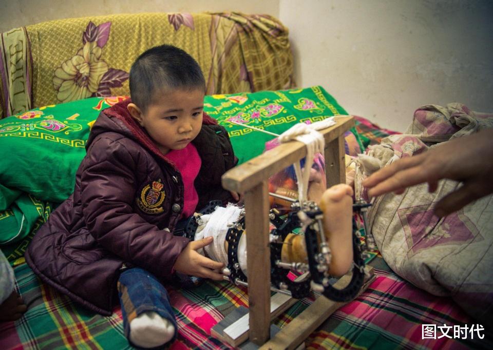 图文时代 幼童遭黑车碾压失去右腿,7旬奶奶学护理,想保住打8枚钢钉的左腿