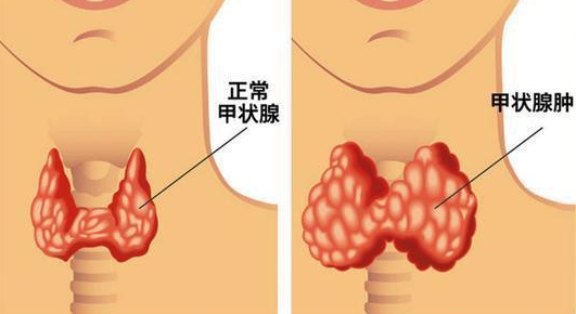 甲状腺结节|甲状腺“散结剂”被找到，白开水排第4，“第1”很少人能坚持
