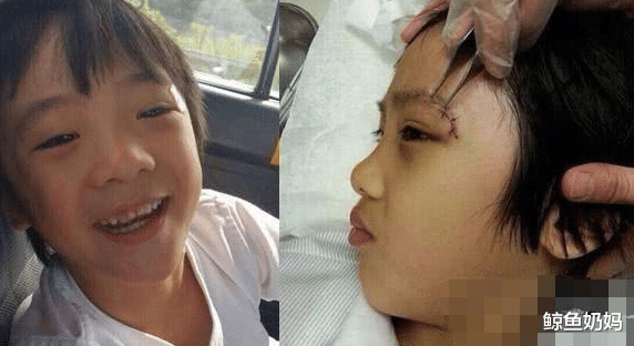 芒果台|他曾为了儿子\手撕\芒果台，如今儿子13岁长成这样伤疤却还在