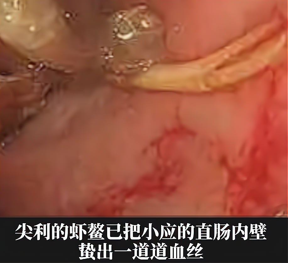兜妈爱叨叨 14岁男孩效仿“荒野求生”，把活龙虾塞进肛门，自称会变成龙虾干