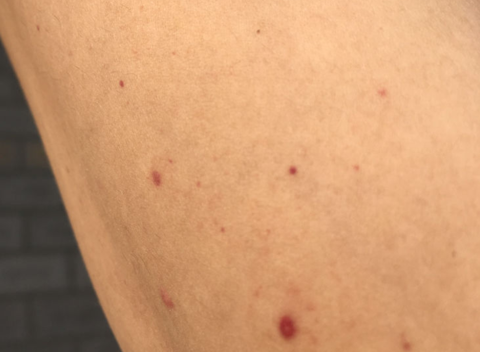 肝脏|手脚若出现4个异常，肝或已“烂如蜂窝”，就算只占一个，也要养养肝了