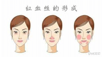 伊美如云|酸类产品用多了,会出现红血丝吗?